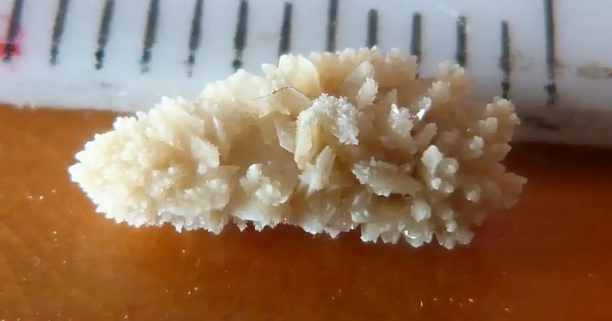 Manyetik Mikro-Robotların Böbrek Taşları Tedavisindeki Rolü ve Klinik Değerlendirmesi